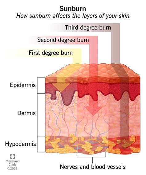 sunburn weeping|Sunburn severity: First and second degree symptoms